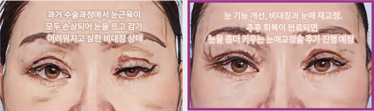 과거 수술과정에서 눈근육이 모두 손상되어 눈을 뜨고 감기 어려워지고 심한 비대칭 상태(좌) / 눈 기능 개선, 비대칭과 눈매 재교정. 추후 회복이 완료되면 눈을 좀더 키우는 눈매교정술 추가 진행 예정(우)