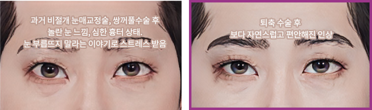 과거 비절개 눈매교정술, 쌍꺼풀수술 후 놀란 눈 느낌, 심한 흉터 상태. 눈 부릅뜨지 말라는 이야기로 스트레스 받음(좌) / 퇴축 수술 후 보다 자연스럽고 편안해진 인상(우)