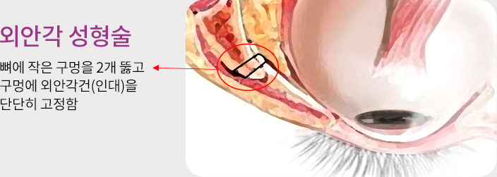 외안각 성형술 - 뼈에 작은 구멍을 2개 뚫고 구멍에 외안각건(인대)을 단단히 고정함