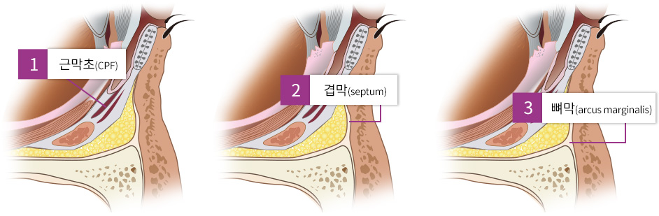 1. 근막초(CPF) / 2. 겹막(septurm) / 3. 뼈막(arcus marginalis)