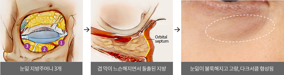 눈밑 지방주머니 3개 > 겹 막이 느슨해지면서 돌출된 지방 > 눈밑이 불룩해지고 고랑, 다크서클 형성됨