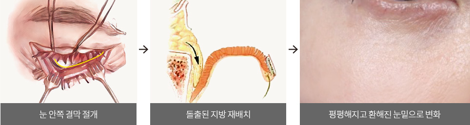 눈 안쪽 결막 절개 > 돌출된 지방 재배치 > 평평해지고 환해진 눈밑으로 변화