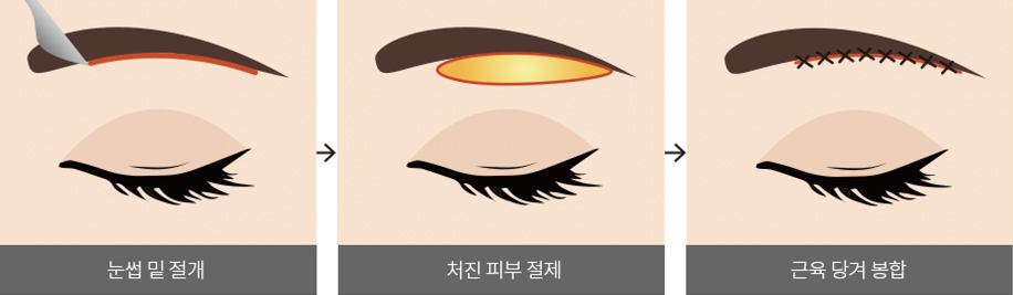 눈썹 밑 절개 > 처진 피부 절제 > 근육 당겨 봉합