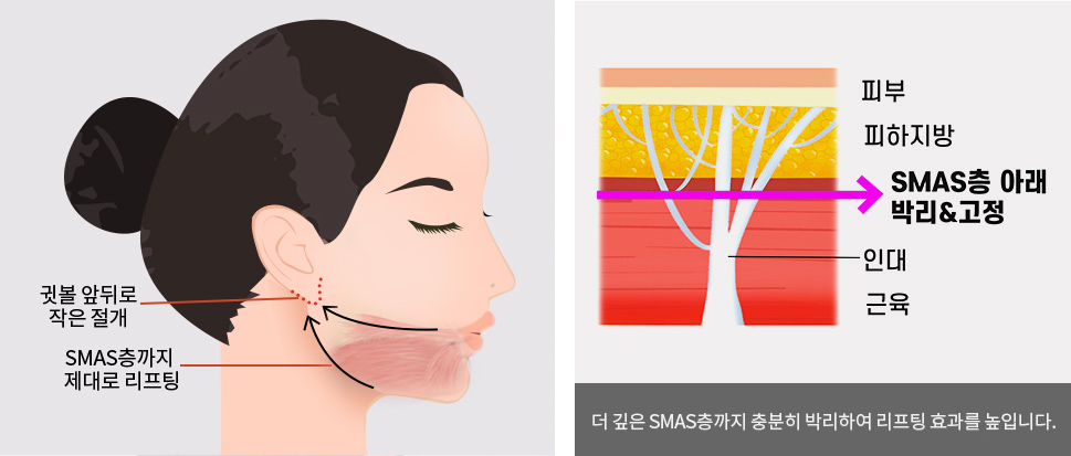 더 깊은 SMAS층까지 충분히 박리하여 리프팅 효과를 높입니다.