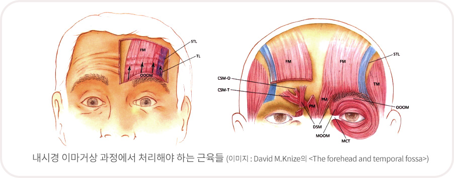 내시경 이마거상 과정에서 처리해야 하는 근육들 (이미지 : David M.Knize의 <The forehead and temporal fossa>)