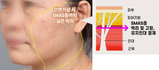 안면거상 시 SMAS층까지 넓은 박리