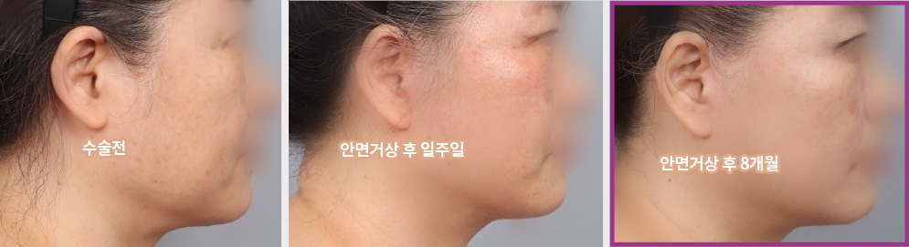 수술전 > 안면거상 후 일주일 > 안면거상 후 8개월