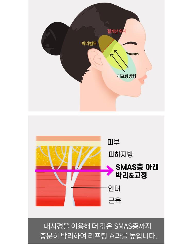 내시경을 이용해 더 깊은 SMAS층까지 충분히 박리하여 리프팅 효과를 높입니다.